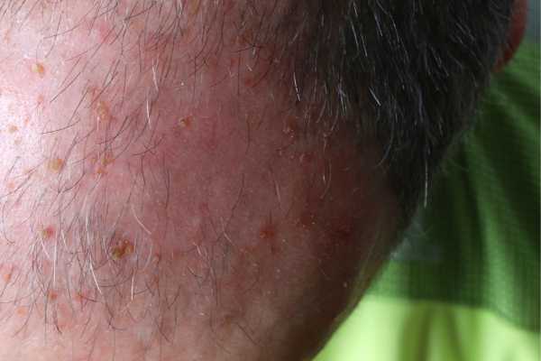 actinic keratosis Removal