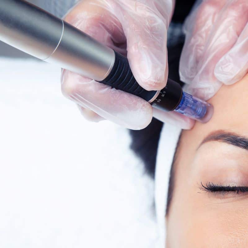 Morpheus8 treatment Perry from Lipo Sculpt - Book in today!