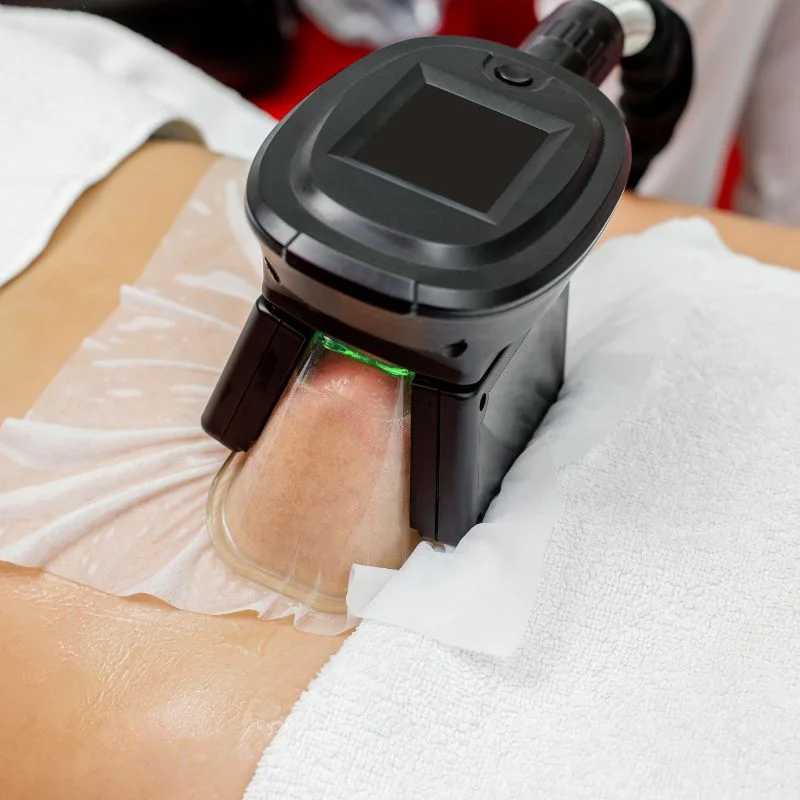 Fat Freezing treatment Perry